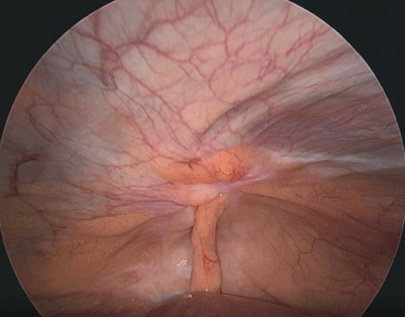 Ernia di Spigelio vista lato sx con grasso epiploico