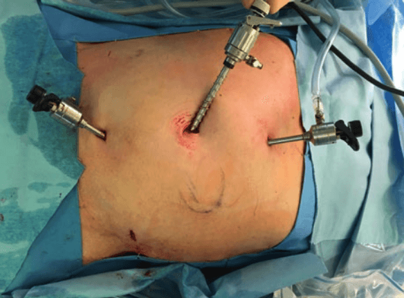 Posizionamento attrezzi per laparoscopia IPOM
